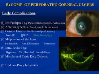 B) COMP. OF PERFORATED CORNEAL ULCERSB) COMP. OF PERFORATED CORNEAL ULCERS
Early Complications
(1) Iris Prolapse ( Big Para central or periph. Perforation )
(2) Anterior synechia ( Small periph. Perforation)
(3) Corneal Fistula ( Small central perforation )
Lost AC IOP River Green Sign
(4) Malposition of the Lens
Sublaxation Ant. Dislocation Extrusion
(5) Intra-ocular Hge
Hyphema Vit., Ret. And choroidal hges
(6) Macular and Optic Disc Oedema
(7) Endo or Panophthalmitis
 