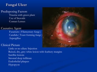 Fungal UlcerFungal Ulcer
Predisposing Factors
Trauma with green plant
Use of Steroids
Contact Lenses
Causative Agent
Fusarium ( Filamentary fungi )
Candida ( Yeast forming fungi )
Aspergillus
Clinical Picture
Little or no ciliary Injection
Raised, dry, grey white lesion with feathery margins
Satellite lesions
Stromal deep infiltrate
Endothelial plaques
Hypopyon
 