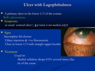 Ulcer with LagophthalmosUlcer with Lagophthalmos
 A primary ulcer in the lower 1/3 of the cornea
Bell’s phenomena
 Symptoms
as usual corneal ulcer ( of vision is not marked..why?)
 Signs
Incomplete lid closure
Ciliary injection & +ve flurorescein
Ulcer in lower 1/3 with straight upper border
 Treatment
Usual ttt
Methyl cellulose drops 0.5% several times/day
ttt of the cause
 