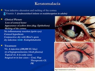 KeratomalaciaKeratomalacia
 Non infective ulceration and melting of the cornea
Vitamin A (malnourished infants or malabsorption in adults)
 Clinical Picture
Loss of corneal luster
Appearance of yellow dots (deg. Epithelium)
Melting of the cornea
No inflammatory reaction (quite eye)
Corneal hypothesia
Conjunctiva: dry with Bitot’s spots
2ry infection Endophthalmitis
 Treatment
Vit. A injection (200,000 IU/day)
ttt of hypoproteinemia ( fresh plasma)
Topical vit. A in early cases
Surgical ttt in late cases : Conj. Flap
Therapeutic CL
PK
 