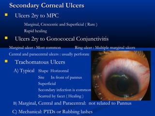 Secondary Corneal UlcersSecondary Corneal Ulcers
 Ulcers 2ry to MPC
Marginal, Crescentic and Superficial ( Rare )
Rapid healing
 Ulcers 2ry to Gonococcal Conjunctivitis
Marginal ulcer : Most common Ring ulcer : Multiple marginal ulcers
Central and paracentral ulcers : usually perforate
 Trachomatous Ulcers
A) Typical Shape Horizontal
Site In front of pannus
Superficial
Secondary infection is common
Scarred by facet ( Healing )
B) Marginal, Central and Paracentral: not related to Pannus
C) Mechanical: PTDs or Rubbing lashes
 