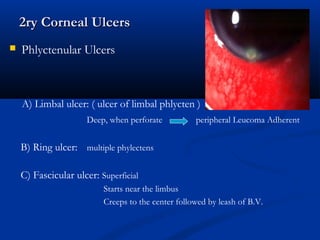 2ry Corneal Ulcers2ry Corneal Ulcers
 Phlyctenular Ulcers
A) Limbal ulcer: ( ulcer of limbal phlycten )
Deep, when perforate peripheral Leucoma Adherent
B) Ring ulcer: multiple phylectens
C) Fascicular ulcer: Superficial
Starts near the limbus
Creeps to the center followed by leash of B.V.
 