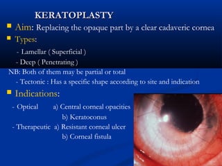 KERATOPLASTYKERATOPLASTY
 Aim: Replacing the opaque part by a clear cadaveric cornea
 Types:
- Lamellar ( Superficial )
- Deep ( Penetrating )
NB: Both of them may be partial or total
- Tectonic : Has a specific shape according to site and indication
 Indications:
- Optical a) Central corneal opacities
b) Keratoconus
- Therapeutic a) Resistant corneal ulcer
b) Corneal fistula
 