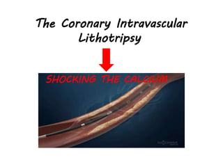 The Coronary Intravascular
Lithotripsy
SHOCKING THE CALCIUM
 