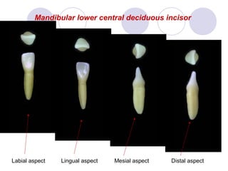 Mandibular lower central deciduous incisor

Labial aspect

Lingual aspect

Mesial aspect

Distal aspect

 
