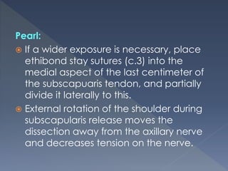 Pearl:
 If a wider exposure is necessary, place
ethibond stay sutures (c.3) into the
medial aspect of the last centimeter of
the subscapuaris tendon, and partially
divide it laterally to this.
 External rotation of the shoulder during
subscapularis release moves the
dissection away from the axillary nerve
and decreases tension on the nerve.
 