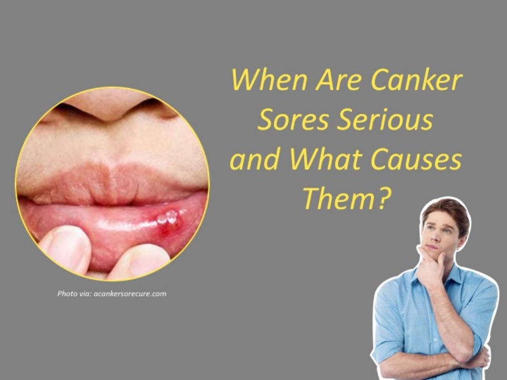 When Are Canker Sores Serious and What Causes Them?
