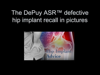 The DePuy ASR™ defective
hip implant recall in pictures
 