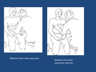 Bilateral lower lobe expansion
Bilateral mid-chest
expansion exercise.
 
