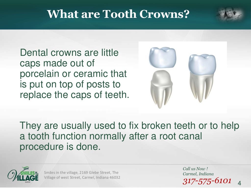 The Difference Between Crowns and Veneers