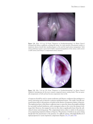 20
THE DIFFICULT AIRWAY
of suspicion should be used in certain syndromes and disease conditions that predispose to
airway narrowing such as thyroid or anterior mediastinal masses. The stable critically nar-
rowed airway refers to the presence of stridor in the absence of respiratory failure or hypoxia.
The implication here is that there is sufﬁcient time to assess the airway thoroughly and plan
for successful tracheal intubation, with contingency plans in the event the primary tech-
nique fails. However, the margin for error in this class is signiﬁcantly lower than the sub-
clinical airway narrowing group. The compromised airway refers to stridor in the presence
of accompanying respiratory distress or hypoxia. The presence of stridor in an acute setting
should alert the practitioner to the presence of a difﬁcult airway, with high likelihood of
rapid progression to acute respiratory compromise (Figures 2.8, 2.9, and 2.10).
Figure 2.8. (Figs. 3.5.3 pg 135 From "Diagnosis in Otorhinolaryngology" by Matin Onerci)
Laryngeal web almost completely occluding the airway. As a rule, presence of hoarseness, stridor, or
respiratory distress should alert anesthesiologists to the need for rapid airway management. Such
airway pathology requires a great deal of skill as repeated manipulation of the airway could convert
a stable airway narrowing to a compromised airway situation.
Figure 2.9. (Fig. 3.5.4 pg 135; From "Diagnosis in Otorhinolaryngology" by Matin Onerci)
Subglottic hemangiomas are the most common congenital tumors causing stridor. They are gener-
ally asymptomatic at birth and may become symptomatic later in life.
 