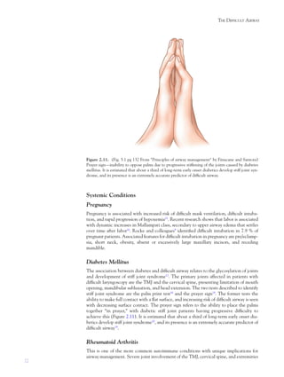 22
THE DIFFICULT AIRWAY
Systemic Conditions
Pregnancy
Pregnancy is associated with increased risk of difﬁcult mask ventilation, difﬁcult intuba-
tion, and rapid progression of hypoxemia15
. Recent research shows that labor is associated
with dynamic increases in Mallampati class, secondary to upper airway edema that settles
over time after labor16
. Rocke and colleagues9
identiﬁed difﬁcult intubation in 7.9 % of
pregnant patients. Associated features for difﬁcult intubation in pregnancy are pre/eclamp-
sia, short neck, obesity, absent or excessively large maxillary incisors, and receding
mandible.
Diabetes Mellitus
The association between diabetes and difﬁcult airway relates to the glycosylation of joints
and development of stiff joint syndrome17
. The primary joints affected in patients with
difﬁcult laryngoscopy are the TMJ and the cervical spine, presenting limitation of mouth
opening, mandibular subluxation, and head extension. The two tests described to identify
stiff joint syndrome are the palm print test18
and the prayer sign19
. The former tests the
ability to make full contact with a ﬂat surface, and increasing risk of difﬁcult airway is seen
with decreasing surface contact. The prayer sign refers to the ability to place the palms
together “in prayer,” with diabetic stiff joint patients having progressive difﬁculty to
achieve this (Figure 2.11). It is estimated that about a third of long-term early onset dia-
betics develop stiff joint syndrome20
, and its presence is an extremely accurate predictor of
difﬁcult airway19
.
Rheumatoid Arthritis
This is one of the more common autoimmune conditions with unique implications for
airway management. Severe joint involvement of the TMJ, cervical spine, and extremities
Figure 2.11. (Fig. 5.1 pg 132 From "Principles of airway management" by Finucane and Santora)
Prayer sign—inability to oppose palms due to progressive stiffening of the joints caused by diabetes
mellitus. It is estimated that about a third of long-term early onset diabetics develop stiff joint syn-
drome, and its presence is an extremely accurate predictor of difﬁcult airway.
 