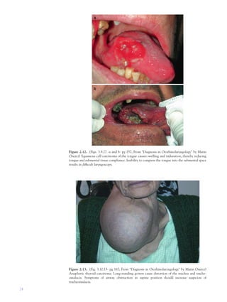 24
Figure 2.12. (Figs. 3.9.27 -a and b- pg 157; From "Diagnosis in Otorhinolaryngology" by Matin
Onerci) Squamous cell carcinoma of the tongue causes swelling and induration, thereby reducing
tongue and submental tissue compliance. Inability to compress the tongue into the submental space
results in difﬁcult laryngoscopy.
Figure 2.13. (Fig. 3.10.13- pg 167; From "Diagnosis in Otorhinolaryngology" by Matin Onerci)
Anaplastic thyroid carcinoma. Long-standing goiters cause distortion of the trachea and trache-
omalacia. Symptoms of airway obstruction in supine position should increase suspicion of
tracheomalacia.
 