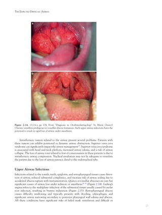 25
THE EXPECTED DIFFICULT AIRWAY
Intrathoracic tumors related to the airway present several problems. Patients with
these tumors can exhibit positional or dynamic airway obstruction. Superior vena cava
syndrome can signiﬁcantly impact the airway management37
. Superior vena cava syndrome
is associated with head and neck plethora, increased airway edema, and a risk of airway
collapse. The loss of airway tone related to loss of consciousness in these patients is due to
intrathoracic airway compression. Tracheal intubation may not be adequate to ventilate
the patient due to the loss of airway patency distal to the endotracheal tube.
Upper Airway Infections
Infections related to the tonsils, teeth, epiglottis, and retropharyngeal tissues cause distor-
tion of airway, reduced submental compliance, and increase risk of airway soiling due to
accidental abscess rupture with instrumentation. Quincy or tonsillar abscesses are rare but
signiﬁcant causes of airway loss under sedation or anesthesia38, 39
(Figure 2.14). Ludwig’s
angina refers to the multiplane infection of the submental tissues usually caused by molar
root infection, resulting in brawny induration (Figure 2.15). Retropharyngeal abscess
causes difﬁculty swallowing and typically presents with drooling, odynophagia, and
signiﬁcant airway narrowing secondary to posterior pharyngeal wall edema and abscess.
All these conditions have signiﬁcant risks of failed mask ventilation and difﬁcult or
Figure 2.14. (3.1.6-a pg 124; From "Diagnosis in Otorhinolaryngology" by Matin Onerci)
Chronic tonsillitis predisposes to tonsillar abscess formation. Such upper airway infections have the
potential to result in rapid loss of airway under anesthesia.
 