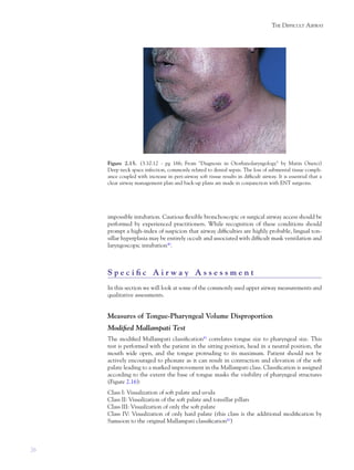 26
THE DIFFICULT AIRWAY
impossible intubation. Cautious ﬂexible bronchoscopic or surgical airway access should be
performed by experienced practitioners. While recognition of these conditions should
prompt a high-index of suspicion that airway difﬁculties are highly probable, lingual ton-
sillar hyperplasia may be entirely occult and associated with difﬁcult mask ventilation and
laryngoscopic intubation40
.
S p e c i ﬁ c A i r w a y A s s e s s m e n t
In this section we will look at some of the commonly used upper airway measurements and
qualitative assessments.
Measures of Tongue-Pharyngeal Volume Disproportion
Modiﬁed Mallampati Test
The modiﬁed Mallampati classiﬁcation41
correlates tongue size to pharyngeal size. This
test is performed with the patient in the sitting position, head in a neutral position, the
mouth wide open, and the tongue protruding to its maximum. Patient should not be
actively encouraged to phonate as it can result in contraction and elevation of the soft
palate leading to a marked improvement in the Mallampati class. Classiﬁcation is assigned
according to the extent the base of tongue masks the visibility of pharyngeal structures
(Figure 2.16):
Class I: Visualization of soft palate and uvula
Class II: Visualization of the soft palate and tonsillar pillars
Class III: Visualization of only the soft palate
Class IV: Visualization of only hard palate (this class is the additional modiﬁcation by
Samsoon to the original Mallampati classiﬁcation42
)
Figure 2.15. (3.10.12 - pg 166; From "Diagnosis in Otorhinolaryngology" by Matin Onerci)
Deep neck space infection, commonly related to dental sepsis. The loss of submental tissue compli-
ance coupled with increase in peri-airway soft tissue results in difﬁcult airway. It is essential that a
clear airway management plan and back-up plans are made in conjunction with ENT surgeons.
 