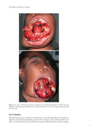 15
THE EXPECTED DIFFICULT AIRWAY
Neck Mobility
Optimal laryngoscopic visualization of the larynx is critically dependent on the ability to
align the oral and pharyngeal long axes (Fig. 2.5). A direct vector of sight would not be
able to reach the larynx if neck mobility is restricted. Although classic teaching suggests
Figure 2.3. (Fig. 3.9.30 (b) pg 158 from "Diagnosis in Otorhinolaryngology" by Matin Onerci)
Squamous cell carcinoma which ﬁlls the oral cavity and prevents access to the upper airway through
the oral route.
 