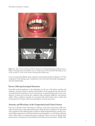 19
THE EXPECTED DIFFICULT AIRWAY
to be associated with difﬁcult mask ventilation and tracheal intubation (Figure 2.7). This
component of the laryngoscopic visualization vector has been historically underappreci-
ated and understudied.
Factors Affecting Laryngeal Structures
Successful tracheal intubation is also dependent on the size of the glottic opening and
subglottic structures. Fixed or dynamic abnormalities of the laryngeal structures prevent
successful tracheal intubation, even in the presence of optimal laryngoscope vector visu-
alization. Several acute and chronic conditions affect laryngeal, subglottic, and tracheal
caliber. These conditions typically are associated with clinical signs such as stridor and
increasing levels of distress with increasing degrees of airway narrowing.
Anatomy and Physiology of the Compromised and Critical Airway
One way to describe airway narrowing is as follows: occult airway narrowing, stable criti-
cally narrowed airway, and compromised airway. Both the latter conditions are associated
with a signiﬁcant risk of difﬁcult mask ventilation, failed tracheal intubation, and the even-
tual need for surgical airway. Subclinical airway narrowing refers to occult diseases affecting
airway caliber with no accompanying signs or symptoms. There is no way to identify these
patients prior to laryngoscopy using standard airway physical exam elements. A high index
Figure 2.7. (Figs. 3.4.6 (a and b) pg 133 From "Diagnosis in Otorhinolaryngology" by Matin Onerci)
Impact of diseased temporomandibular joint on mouth opening. Here left sided TMJ ankylosis seen
on the coronal CT causes severe trismus and impossible laryngoscopy.
 