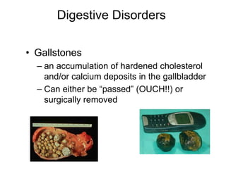 Digestive Disorders 
• Gallstones 
– an accumulation of hardened cholesterol 
and/or calcium deposits in the gallbladder 
– Can either be “passed” (OUCH!!) or 
surgically removed 
 