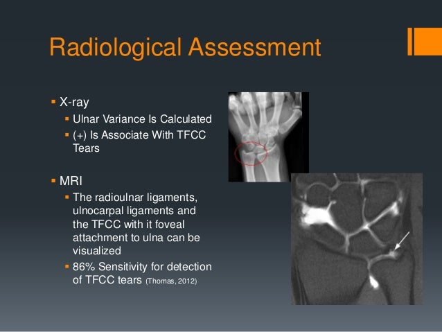 picture Tfcc Anatomy Radiology the distal radioulnar joint and tfcc