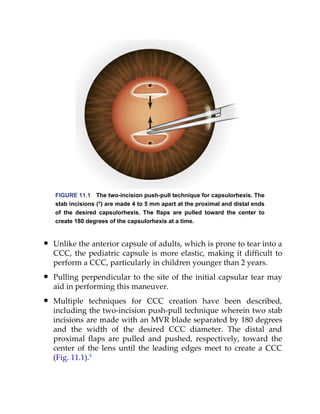 Manual of Corneal and Cataract Surgery.. | PDF