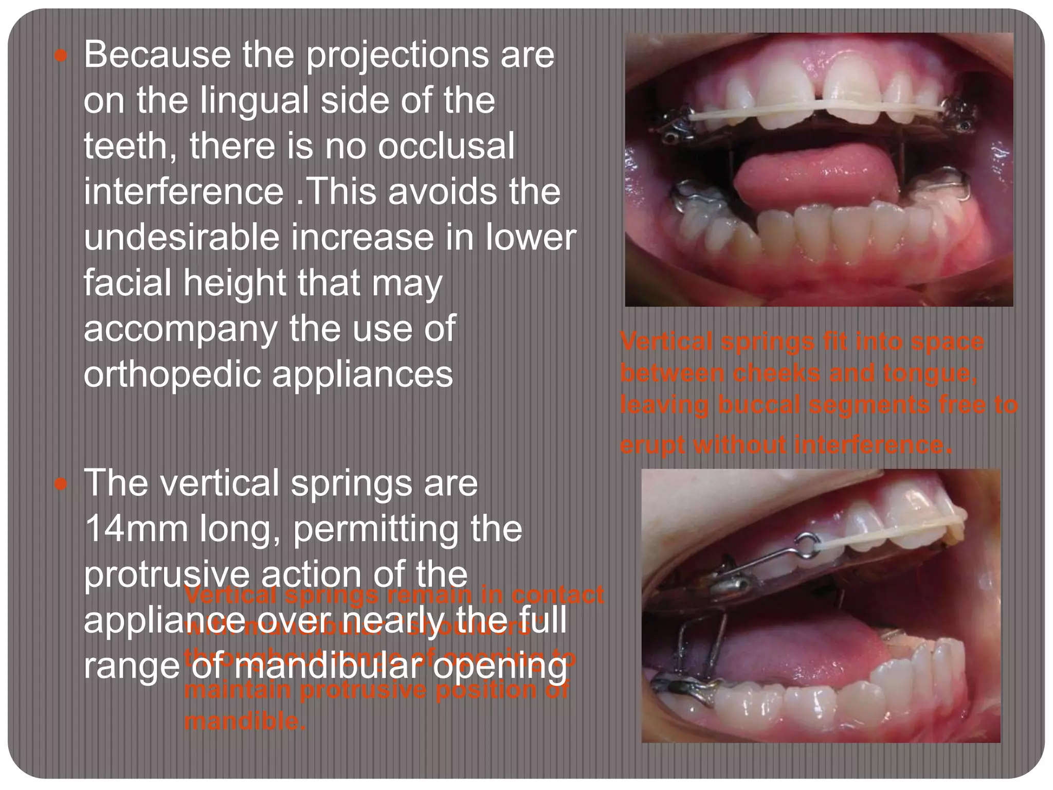 Vertical springs remain in contact
with mandibular “shoulders”
throughout range of opening to
maintain protrusive position of
mandible.
Vertical springs fit into space
between cheeks and tongue,
leaving buccal segments free to
erupt without interference.
 Because the projections are
on the lingual side of the
teeth, there is no occlusal
interference .This avoids the
undesirable increase in lower
facial height that may
accompany the use of
orthopedic appliances
 The vertical springs are
14mm long, permitting the
protrusive action of the
appliance over nearly the full
range of mandibular opening
 