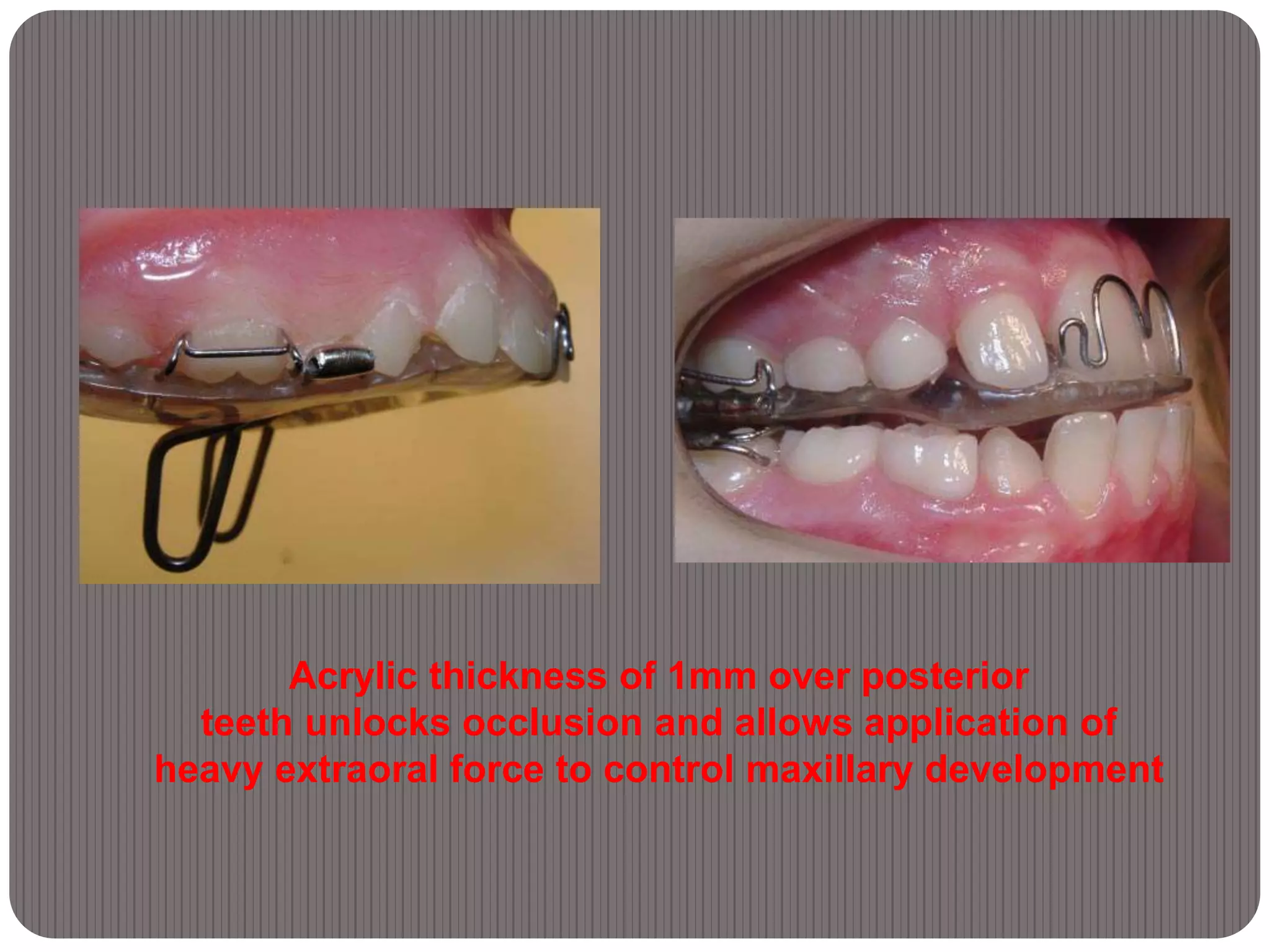 Acrylic thickness of 1mm over posterior
teeth unlocks occlusion and allows application of
heavy extraoral force to control maxillary development
 