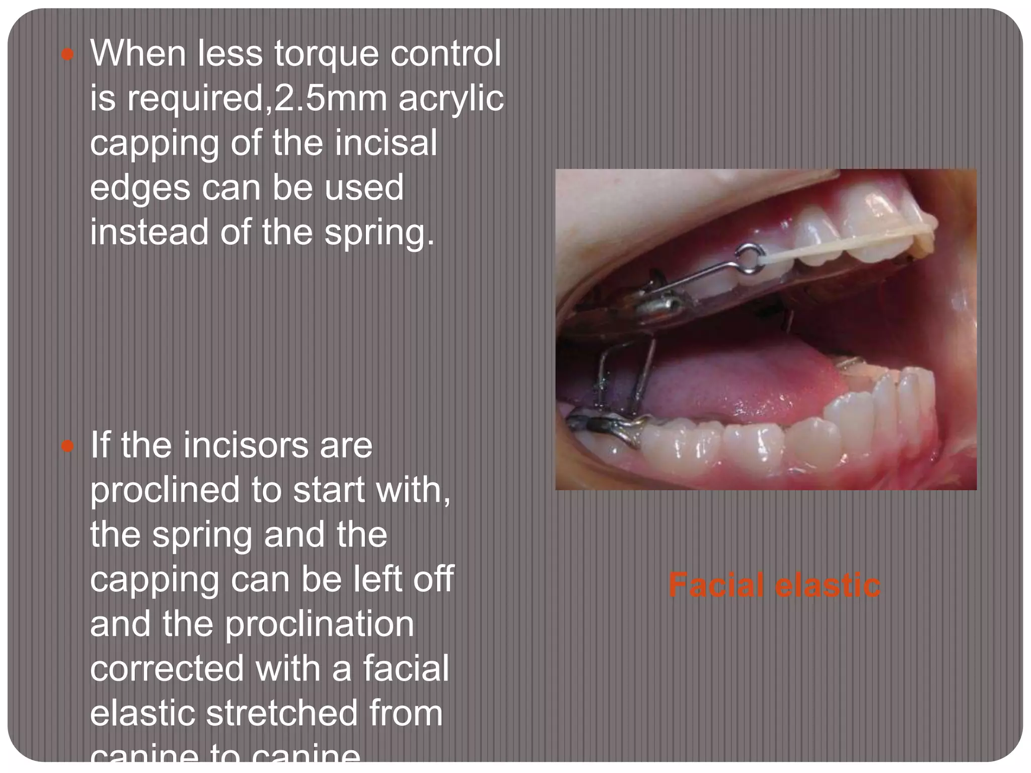 Facial elastic
 When less torque control
is required,2.5mm acrylic
capping of the incisal
edges can be used
instead of the spring.
 If the incisors are
proclined to start with,
the spring and the
capping can be left off
and the proclination
corrected with a facial
elastic stretched from
canine to canine
 
