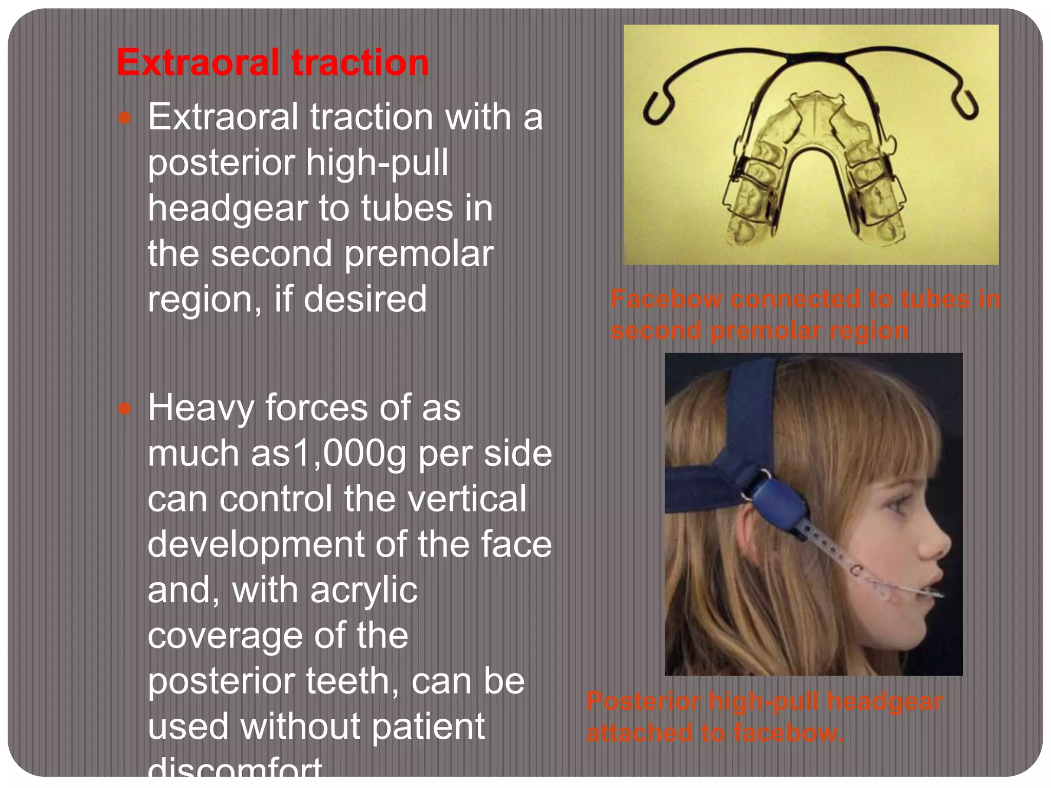 Facebow connected to tubes in
second premolar region
Posterior high-pull headgear
attached to facebow.
Extraoral traction
 Extraoral traction with a
posterior high-pull
headgear to tubes in
the second premolar
region, if desired
 Heavy forces of as
much as1,000g per side
can control the vertical
development of the face
and, with acrylic
coverage of the
posterior teeth, can be
used without patient
discomfort.
 