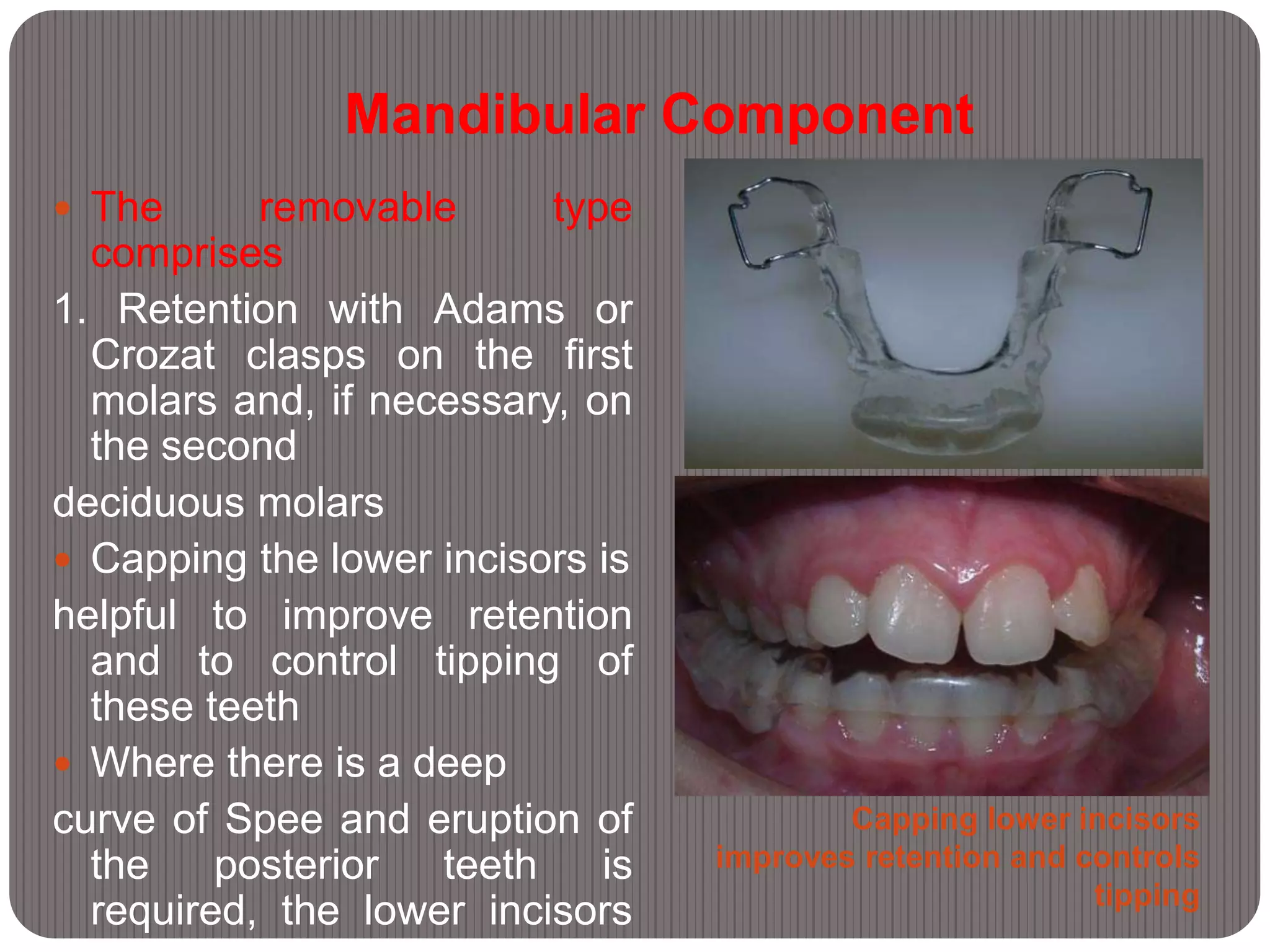 Mandibular Component
Capping lower incisors
improves retention and controls
tipping
 The removable type
comprises
1. Retention with Adams or
Crozat clasps on the first
molars and, if necessary, on
the second
deciduous molars
 Capping the lower incisors is
helpful to improve retention
and to control tipping of
these teeth
 Where there is a deep
curve of Spee and eruption of
the posterior teeth is
required, the lower incisors
 