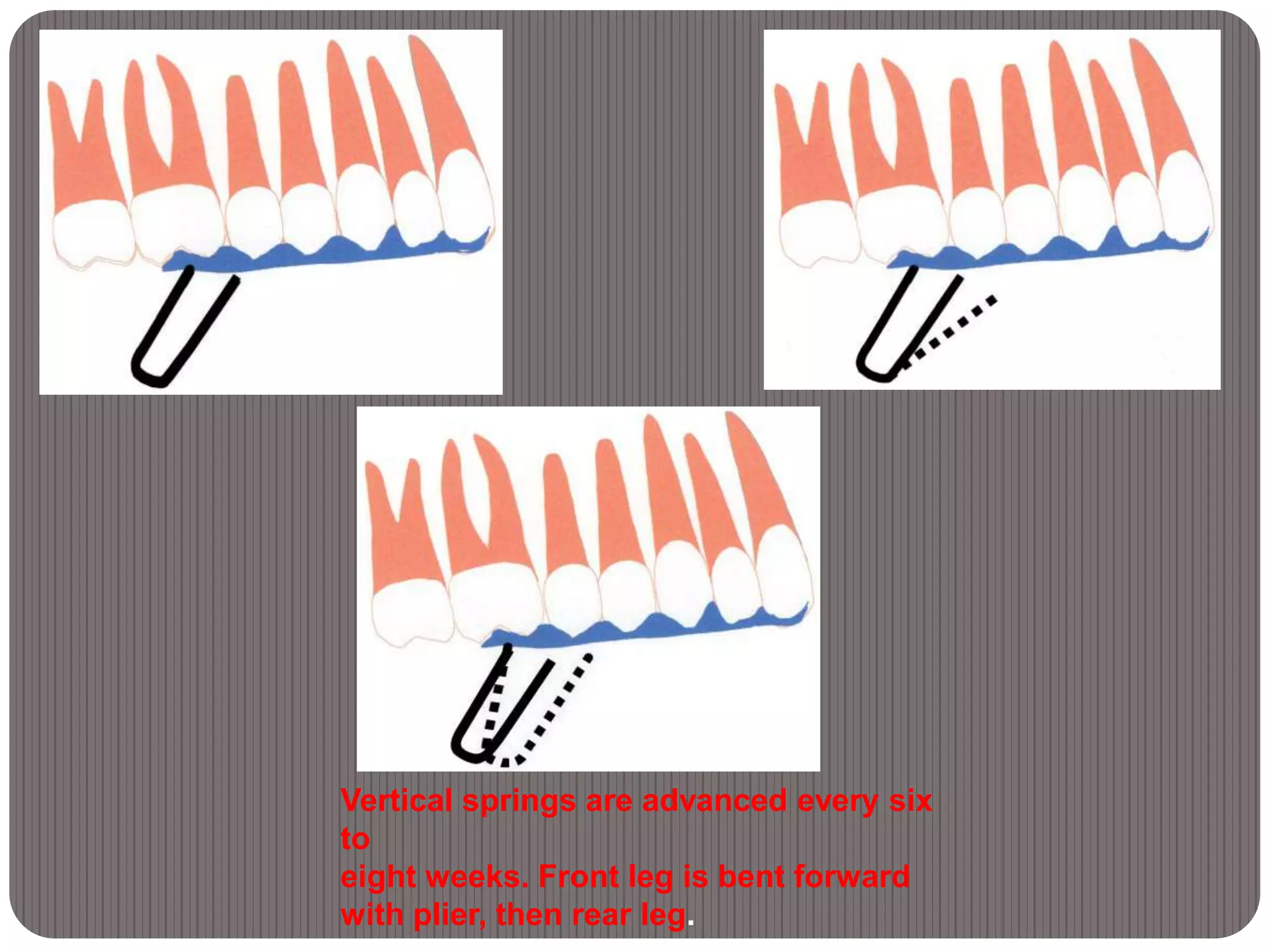 Vertical springs are advanced every six
to
eight weeks. Front leg is bent forward
with plier, then rear leg.
 