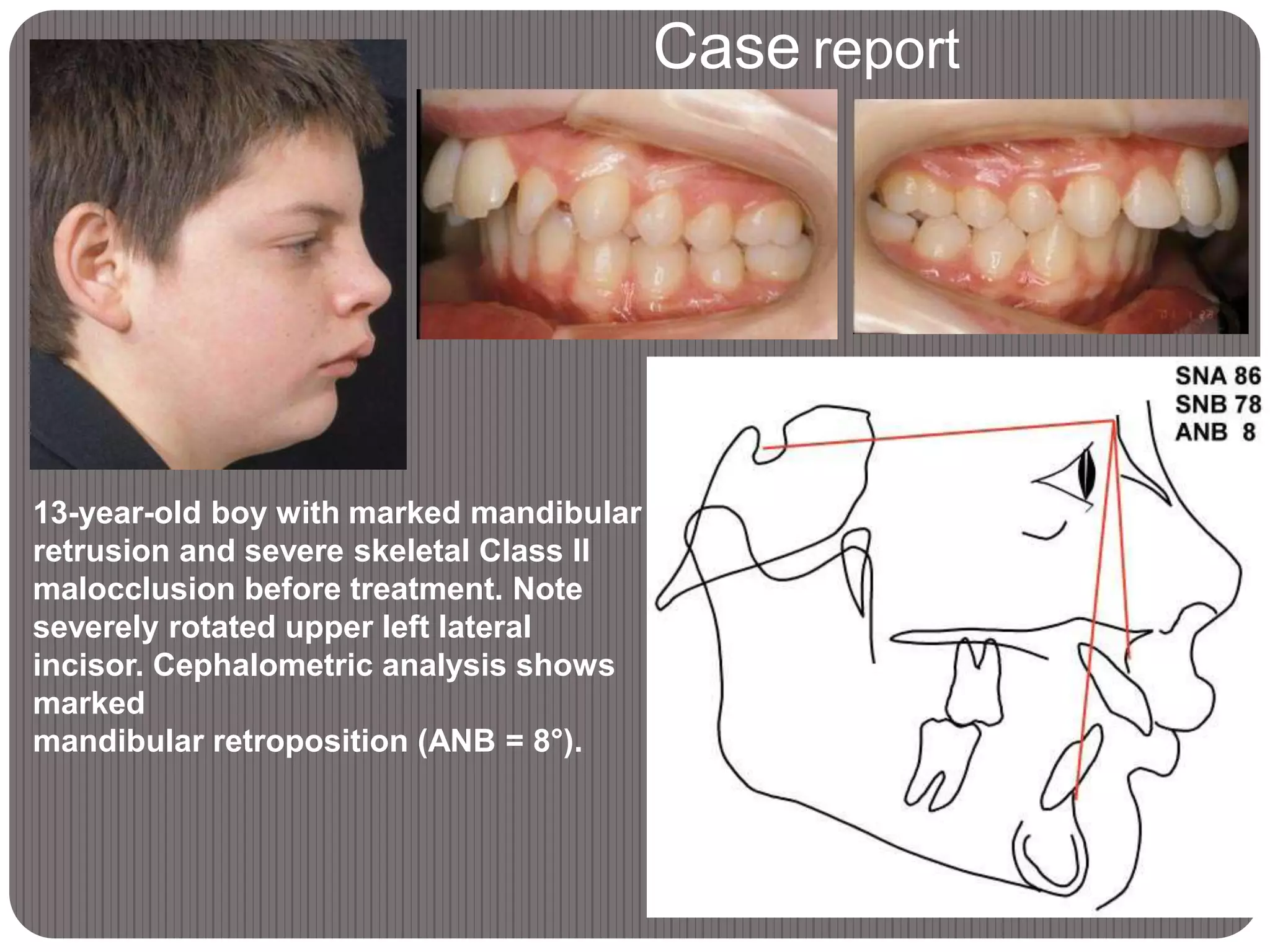 Case report
13-year-old boy with marked mandibular
retrusion and severe skeletal Class II
malocclusion before treatment. Note
severely rotated upper left lateral
incisor. Cephalometric analysis shows
marked
mandibular retroposition (ANB = 8°).
 