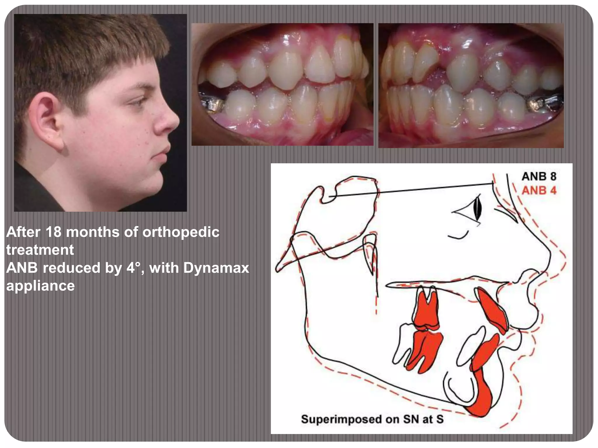 After 18 months of orthopedic
treatment
ANB reduced by 4°, with Dynamax
appliance
 