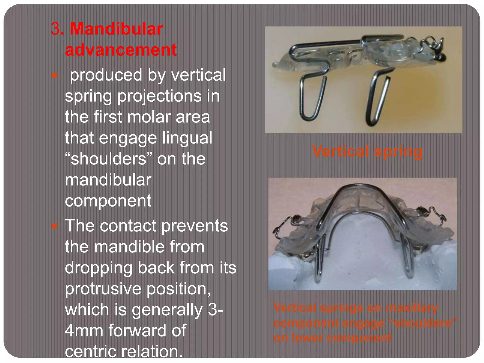 Vertical spring
Vertical springs on maxillary
component engage “shoulders”
on lower component
3. Mandibular
advancement
 produced by vertical
spring projections in
the first molar area
that engage lingual
“shoulders” on the
mandibular
component
 The contact prevents
the mandible from
dropping back from its
protrusive position,
which is generally 3-
4mm forward of
centric relation.
 
