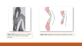 Figure 30.5 Resorption of the root of a primary
incisor owing to pressure from the erupting
successor
Figure 30.6 Angulation of permanent and primary incisors
 
