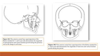 Figure 18.2 This anterior cranial base superimposition of the
Bolton standard for 3- and 6-year-olds demonstrates the magnitude
of anteroposterior and vertical skeletal growth during this period as
well as the change in soft tissue . Figure 18.3 This anterior cranial base superimposition of the Bolton standard for
3- and 6-year-olds demonstrates the magnitude of transverse and vertical skeletal
growth during this period.
 
