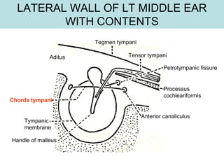 Tegmen tympani
Tensor tympani
Petrotympanic fissure
Anterior canaliculus
Chorda tympani
Tympanic
membrane
Handle of malleus
Processus
cochleariformis
Aditus
LATERAL WALL OF LT MIDDLE EAR
WITH CONTENTS
 