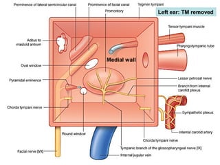 25
Left ear: TM removed
Medial wall
 