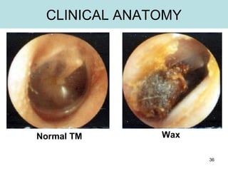 36
CLINICAL ANATOMY
Normal TM Wax
 