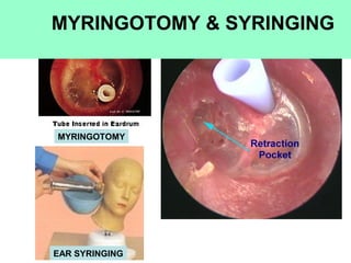 MYRINGOTOMY
MYRINGOTOMY & SYRINGING
EAR SYRINGING
 