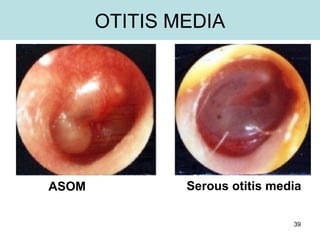 39
OTITIS MEDIA
Serous otitis mediaASOM
 