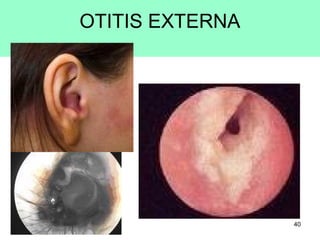 40
OTITIS EXTERNA
 