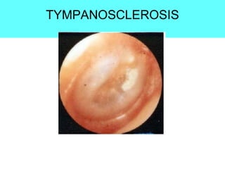 TYMPANOSCLEROSIS
 