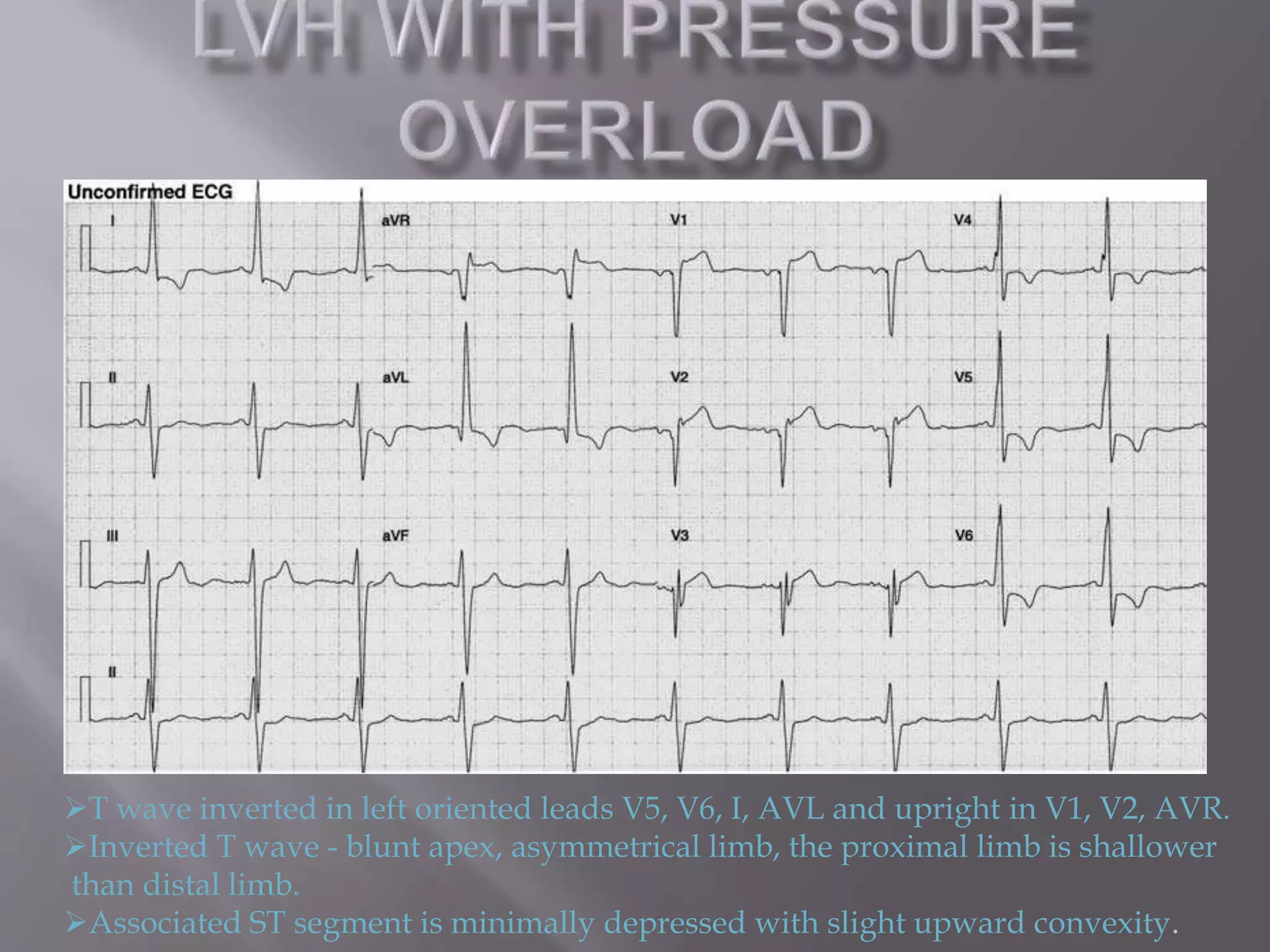 The ecg in chmaber enlargement approach | PPTX