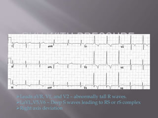 Avr Terminal R Wave The ecg in chmaber enlargement approach | PPTX