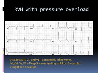 Avr R Wave The ECG in chmaber enlargement final.pptx