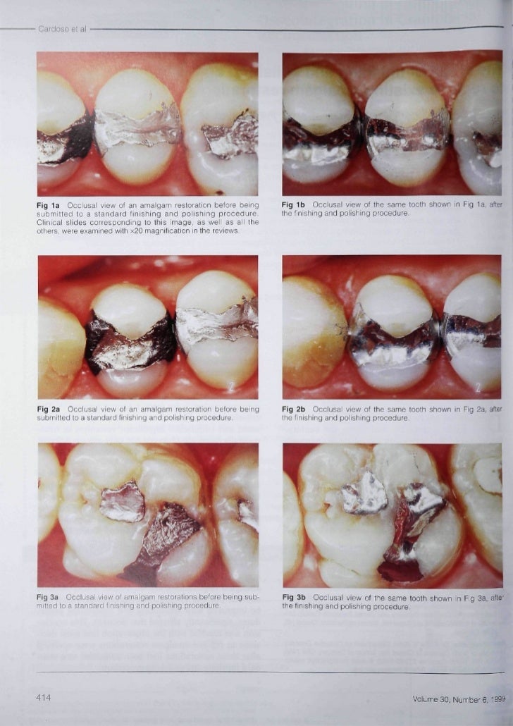 The effect of finishing and polishing on the decision to replace exis…