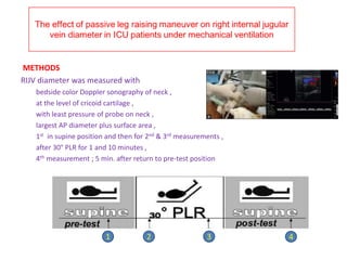 The effect of passive leg raising maneuver on RIJ vein diameter in icu patients under mechanical ventilation