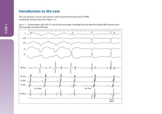 The_EHRA_Book_of_Interventional Electrophysiology.pdf