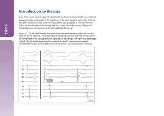 The_EHRA_Book_of_Interventional Electrophysiology.pdf