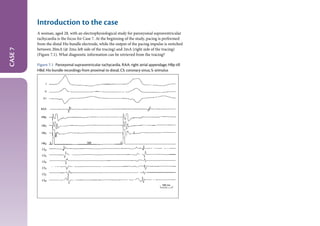 The_EHRA_Book_of_Interventional Electrophysiology.pdf